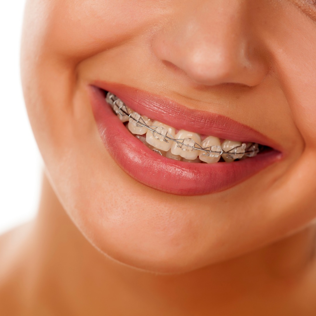 Invisible Braces cost in Summerlin