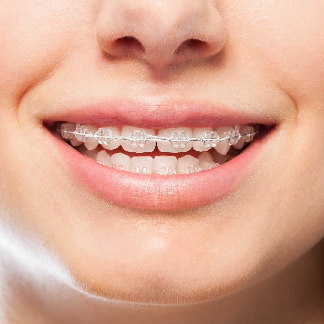 Lingual Braces cost in Summerlin 