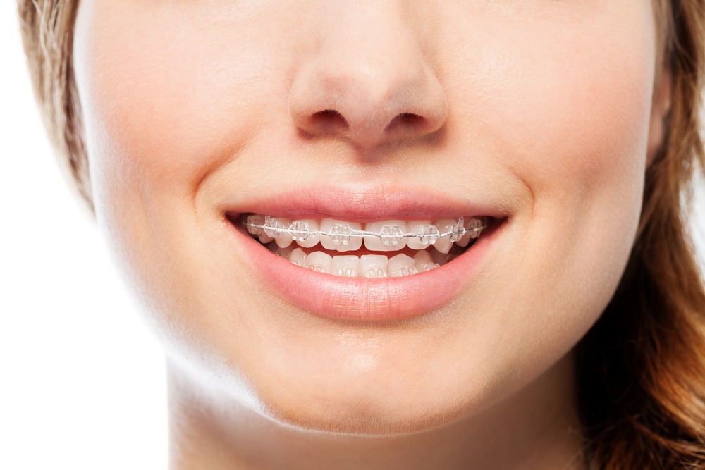 Affordable Invisible Braces Summerlin NV 