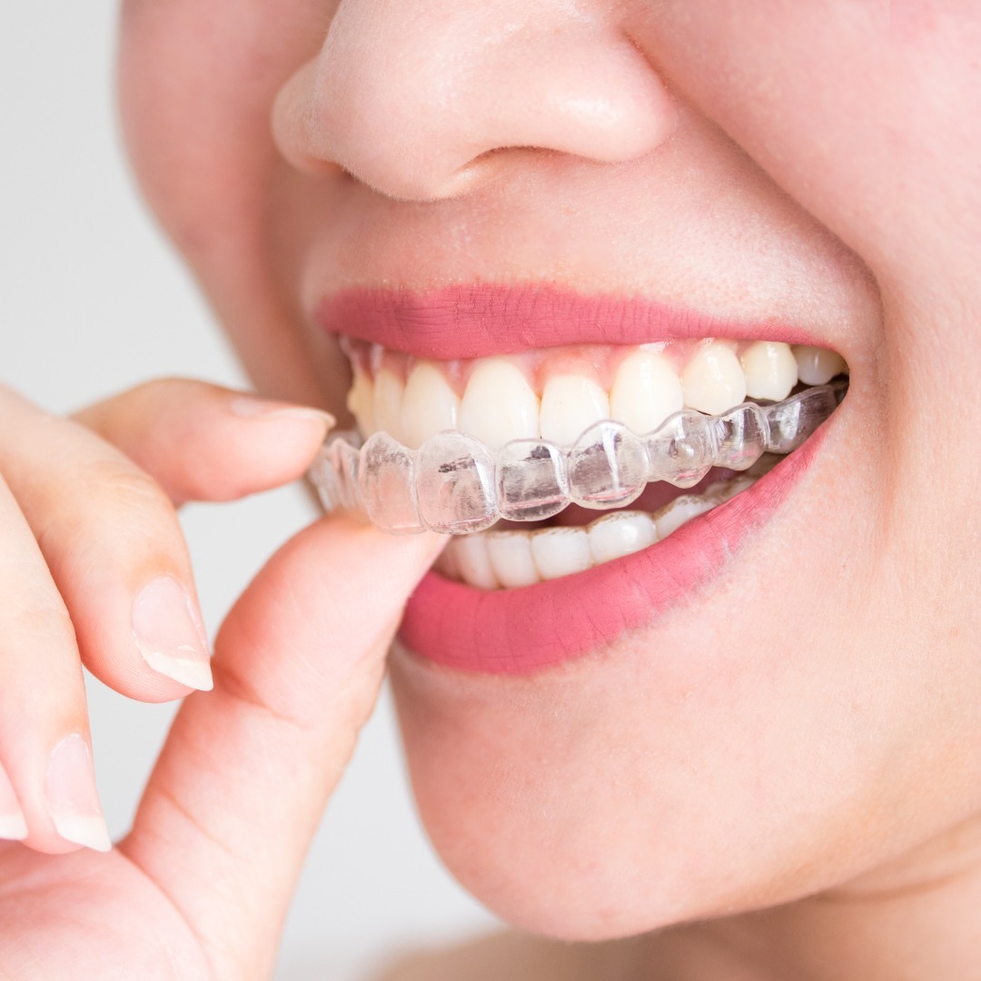 Affordable Invisalign quotes Summerlin NV 