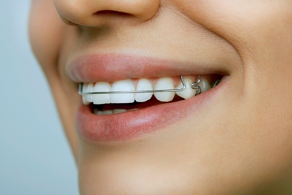 Best Affordable Summerlin Orthodontic Retainers